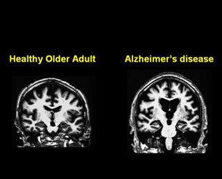 Two MRI images side by side.  One shows the brain of a healthy older adult, the other shows a brain of an adult with Alzheimer's disease.