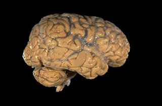 Photo of a human brain.